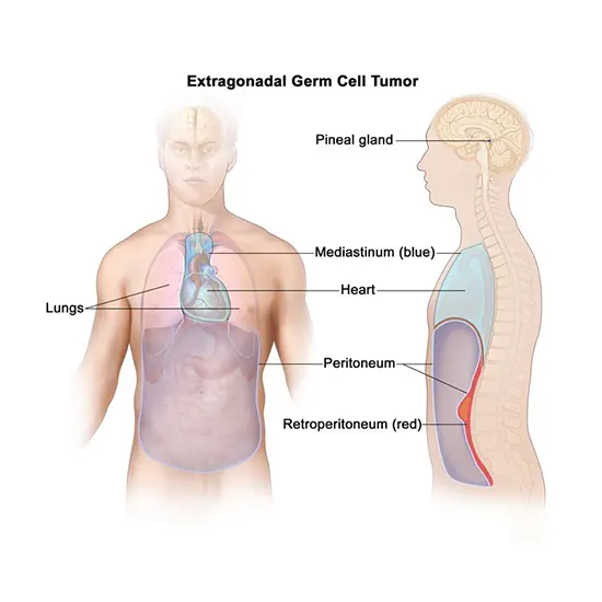 extragonadal germ cell tumor